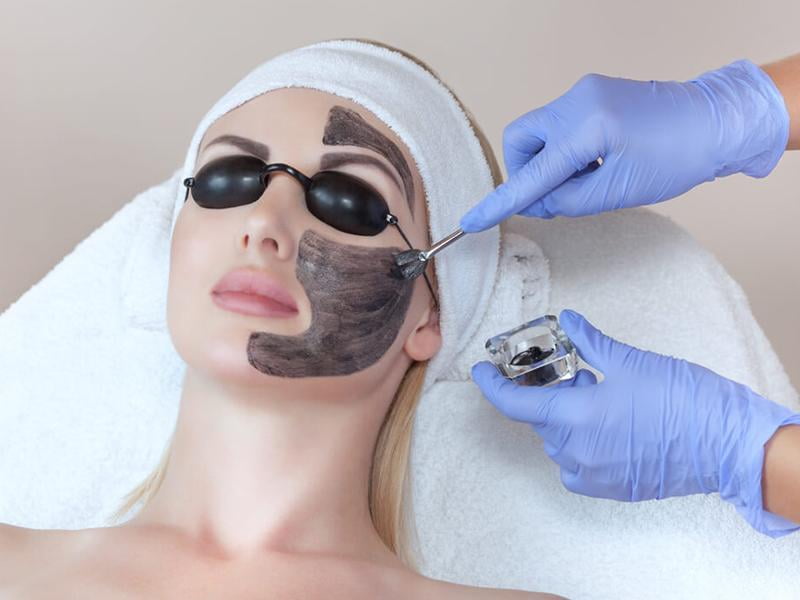 Carbon Peel